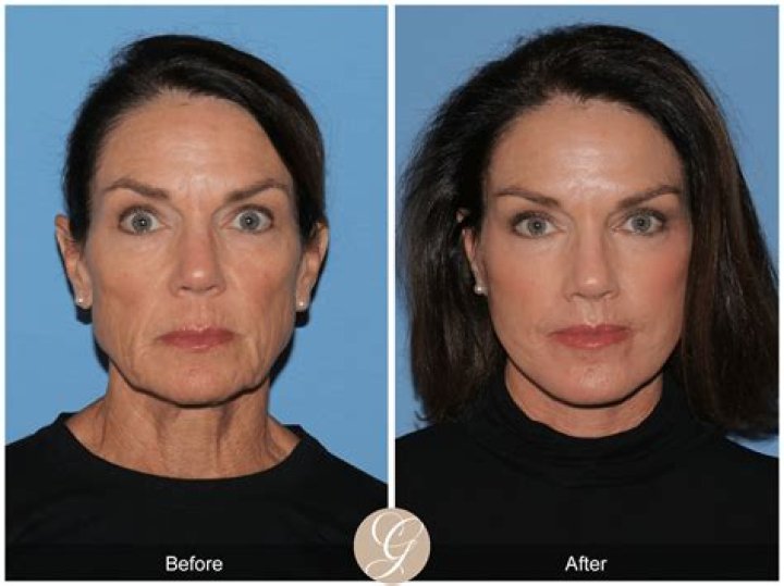 What Surgery Did Karla J Get? Before And After Photos Of The Model And Fitness Freak